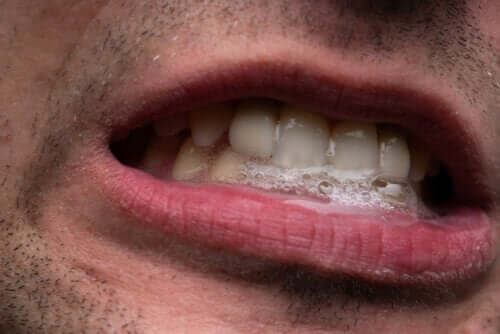 Sialorrhée : causes et traitement
