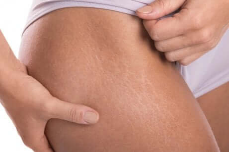 Des vergetures sur les cuisses.