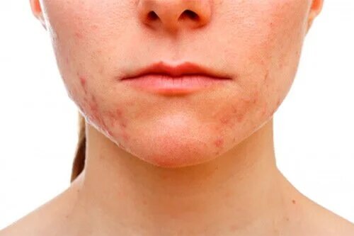 L'acné conglobata laisse des cicatrices qui minent la confiance en eux des victimes.