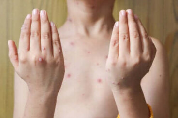Herpès zoster chez les enfants : causes, symptômes et traitements