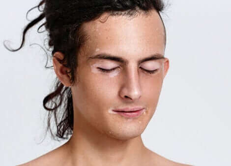 Un homme ayant du vitiligo.