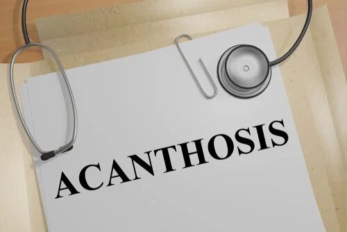 Causes de l'acanthose pigmentaire