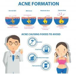 Graphique d'explication de la formation de l'acné.