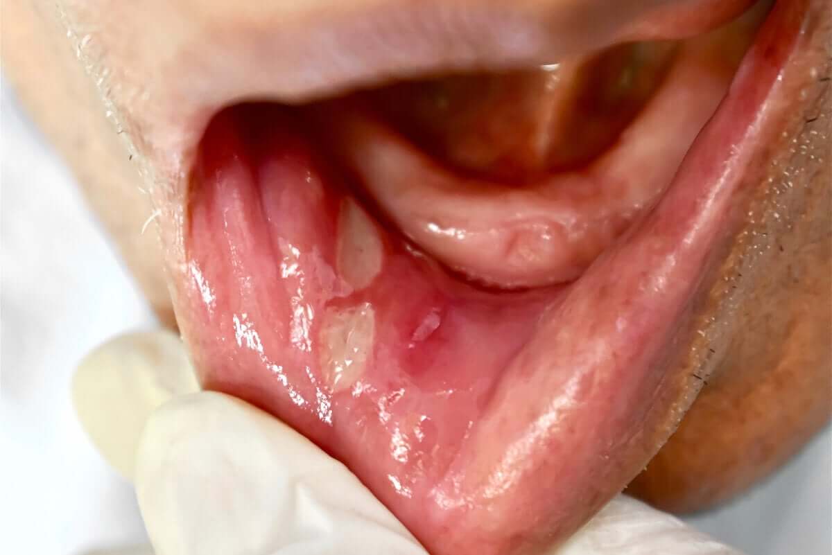 Des aphtes dans la bouche.