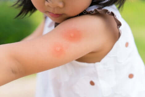Piqûres de moustique sur le bras d'une petite fille. 