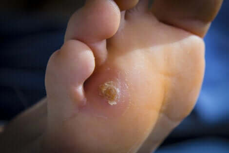 Une callosité sous le pied.