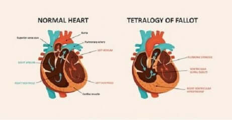 Schéma du coeur dans la tétralogie de Fallot. 