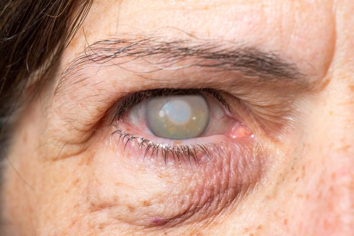 Une femme atteinte de cataracte.