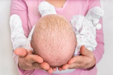 Les traitements de la croûte de lait et de l’acné du nourrisson