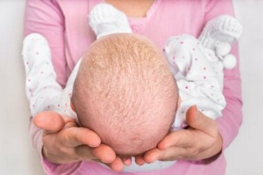 La croûte de lait chez les bébés.
