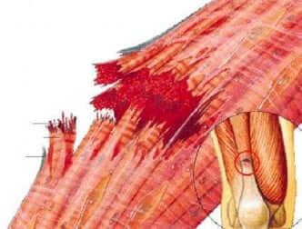 Une déchirure musculaire.