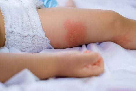 Dermatite sur la cuisse d'un bébé.