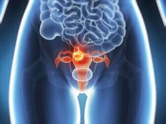 Endométriose chez une femme.