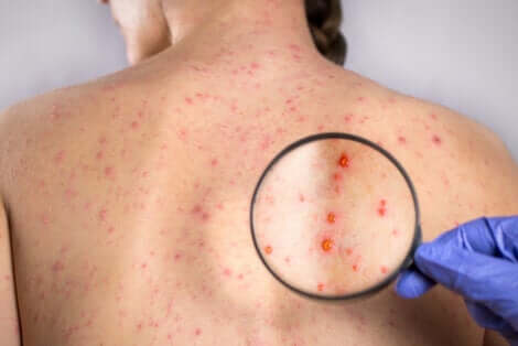 Des lésions de la rubéole.