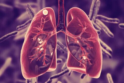 Qu'est-ce que la tuberculose pulmonaire et quels sont ses symptômes ?