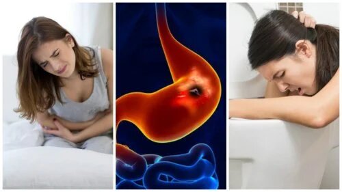 L'ulcère peptique est un ulcère dans la région de l'estomac.