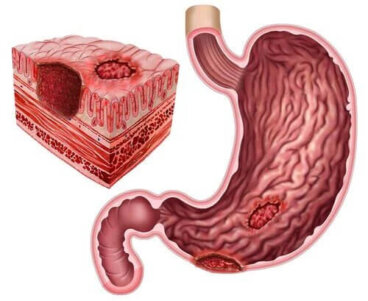 Ulcère peptique et Helicobacter pylori
