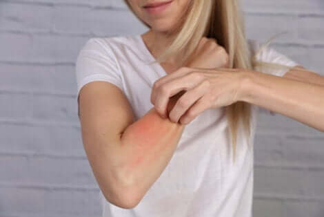 Une dermatite sur un bras.