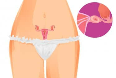 Evolution de la grossesse ectopique.