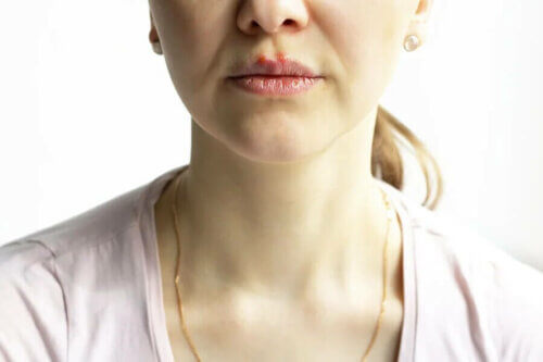 Une femme atteinte de pemphigus vulgaire.