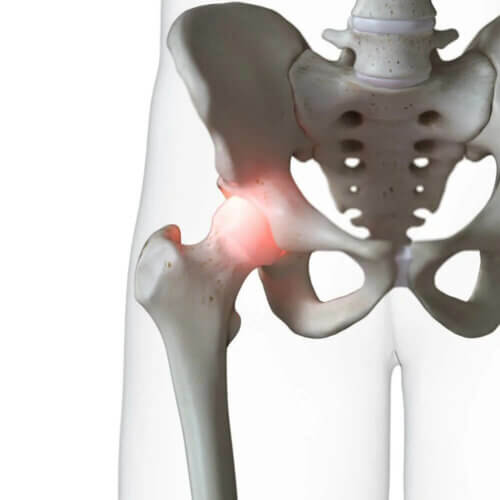 Le conflit de la hanche mal soigné peut mener à de l'arthrose.