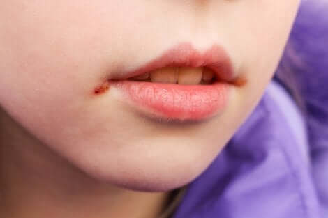 Impétigo sur la bouche d'un enfant.