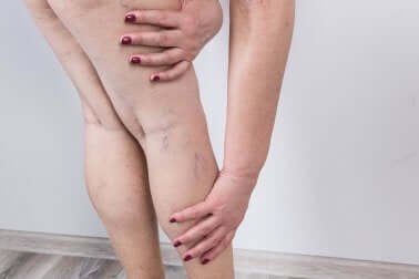 Rétention d'eau dans les jambes.