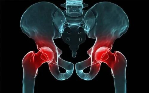 La dysplasie de la hanche est une malformation multi-factorielles.