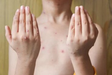 Pemphigus vulgaire : symptômes et traitements