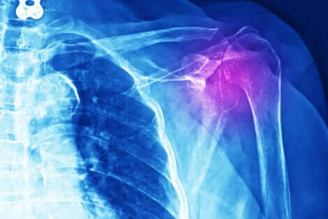 La radiographie d'une tendinite.