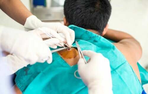 Un patient se faisant faire une biopsie.