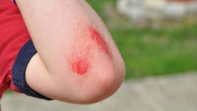 Une blessure infectée.