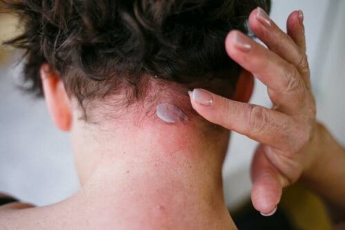 Dermatite séborrhéique : symptômes et traitement