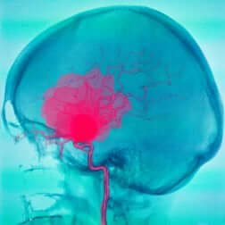 Hémorragie cérébrale.