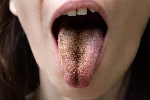 Langue poilue noire : causes, symptômes et conseils