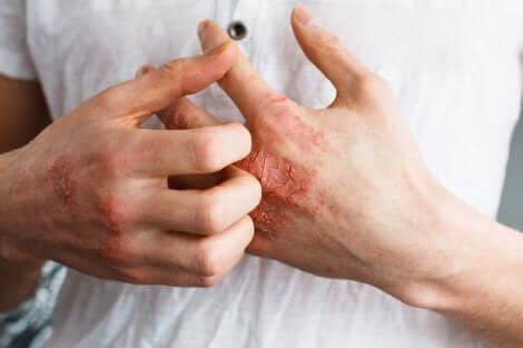 Deux mains souffrant de dermatite. 