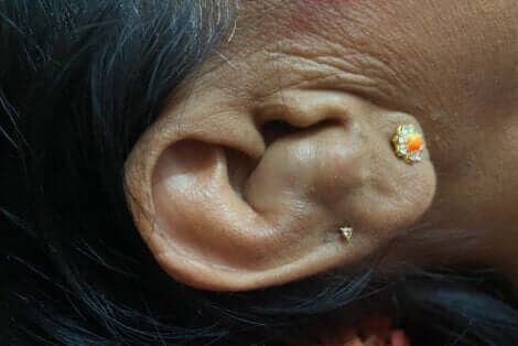 Une oreille en chou-fleur.
