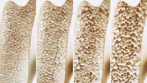 Des os avec de l'ostéoporose.