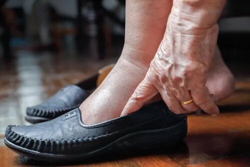 5 clés pour les jambes gonflées par la chaleur