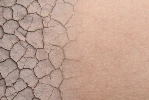 Diprogenta permet de traiter les problèmes de peau à risque d'infection
