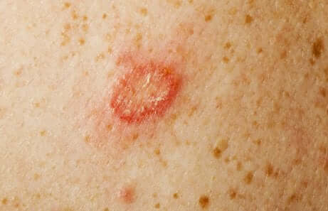 Les symptômes de la sporotrichose.