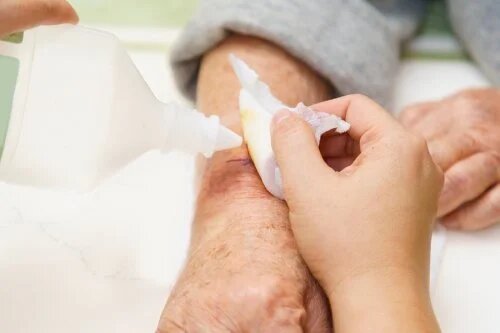 Ulcères de pression : soins et conseils
