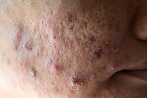 Une personne souffrant d'acné sévère.