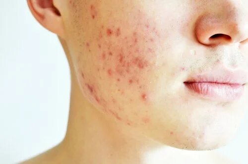 Qu'est-ce que l'acné kystique ?