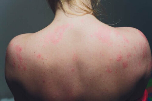 Qu'est-ce que l'actinodermatose ?
