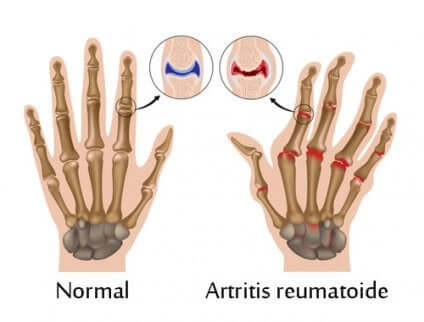 Schéma de mains, normale et souffrant d'arthrite. 