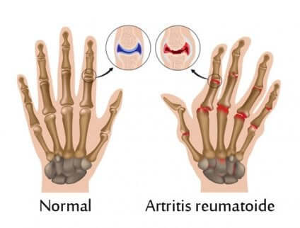 Schéma de mains, normale et souffrant d'arthrite.