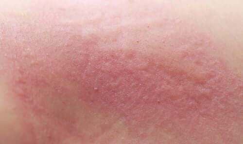 Une irritation cutanée.
