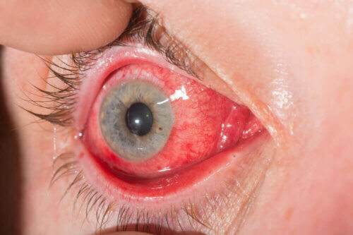 Un oeil atteint de conjonctivite.