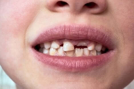 Dents de lait d'un enfant.